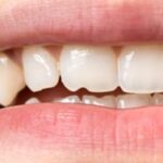 牙齒裂開一小塊